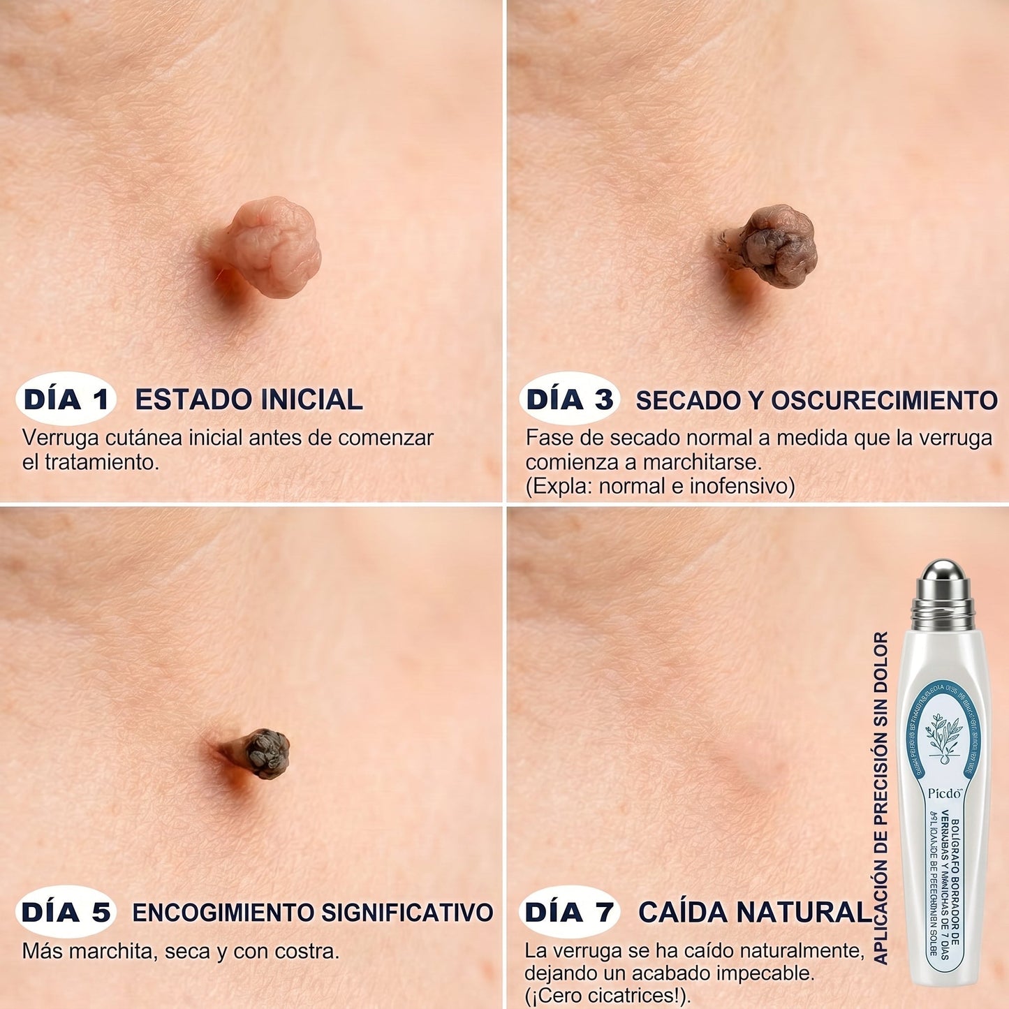 𝐏𝐢𝐜𝐝𝐨® Borrador de Verrugas y Manchas en 7 Días💗💗(𝐀𝐩𝐥𝐢𝐜𝐚𝐝𝐨𝐫 𝐫𝐨𝐥𝐥-𝐨𝐧: 𝐬𝐢𝐧 𝐝𝐨𝐥𝐨𝐫 𝐧𝐢 𝐜𝐢𝐜𝐚𝐭𝐫𝐢𝐜𝐞𝐬)✨