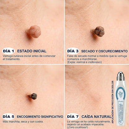 𝐏𝐢𝐜𝐝𝐨® Borrador de Verrugas y Manchas en 7 Días💗💗(𝐀𝐩𝐥𝐢𝐜𝐚𝐝𝐨𝐫 𝐫𝐨𝐥𝐥-𝐨𝐧: 𝐬𝐢𝐧 𝐝𝐨𝐥𝐨𝐫 𝐧𝐢 𝐜𝐢𝐜𝐚𝐭𝐫𝐢𝐜𝐞𝐬)✨