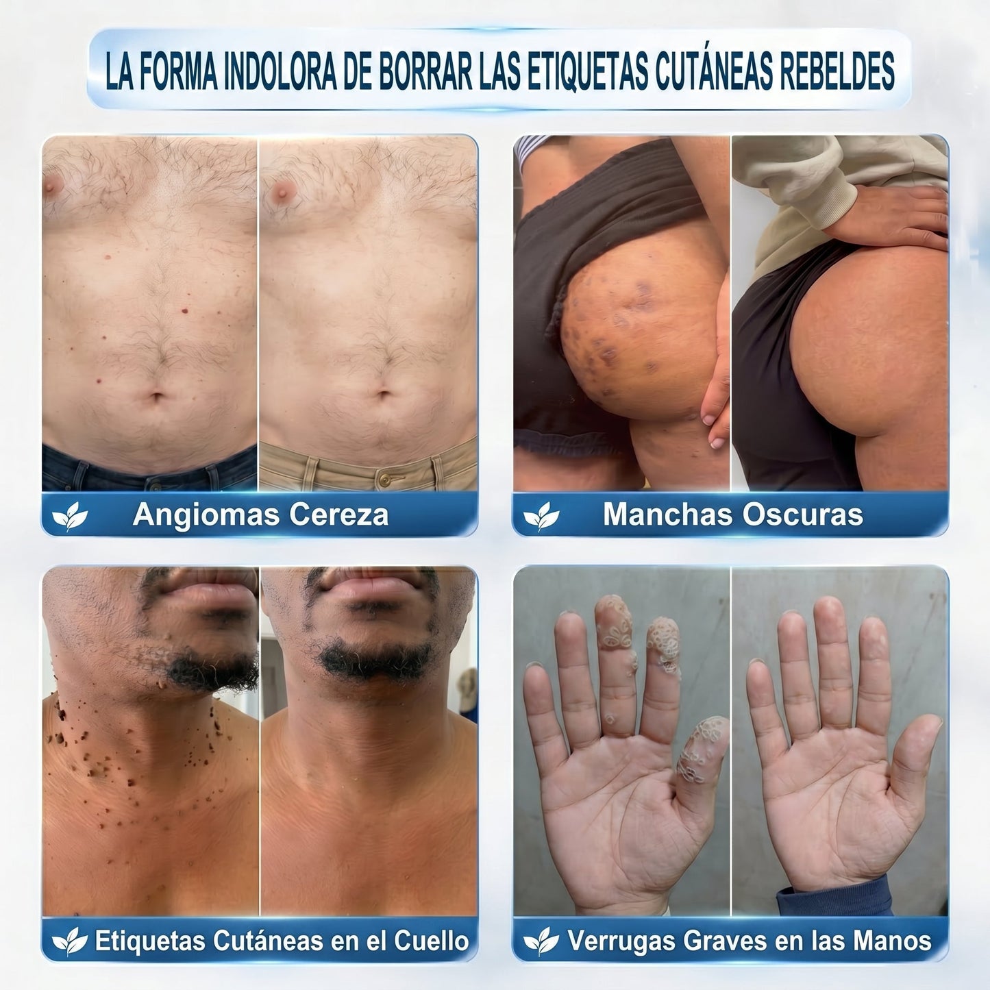 𝐏𝐢𝐜𝐝𝐨® Borrador de Verrugas y Manchas en 7 Días💗💗(𝐀𝐩𝐥𝐢𝐜𝐚𝐝𝐨𝐫 𝐫𝐨𝐥𝐥-𝐨𝐧: 𝐬𝐢𝐧 𝐝𝐨𝐥𝐨𝐫 𝐧𝐢 𝐜𝐢𝐜𝐚𝐭𝐫𝐢𝐜𝐞𝐬)✨
