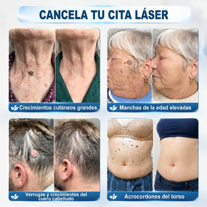 𝐏𝐢𝐜𝐝𝐨® Borrador de Verrugas y Manchas en 7 Días💗💗(𝐀𝐩𝐥𝐢𝐜𝐚𝐝𝐨𝐫 𝐫𝐨𝐥𝐥-𝐨𝐧: 𝐬𝐢𝐧 𝐝𝐨𝐥𝐨𝐫 𝐧𝐢 𝐜𝐢𝐜𝐚𝐭𝐫𝐢𝐜𝐞𝐬)✨